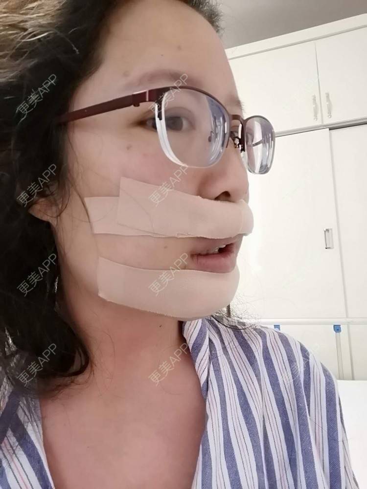 分享到:凸嘴矫正价格推荐商品【凸嘴矫正】突嘴矫正 上下颚地包天