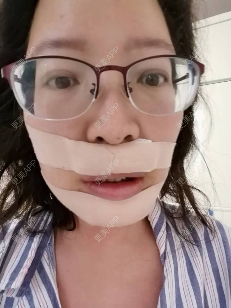 分享到:凸嘴矫正价格推荐商品【凸嘴矫正】突嘴矫正 上下颚地包天