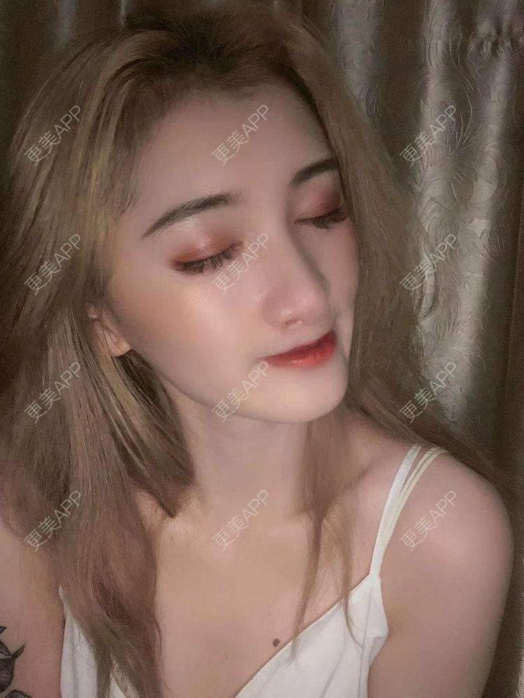 更美 - 最美的期待i的鼻形态修复经验 | 广州 | 鼻形态修复