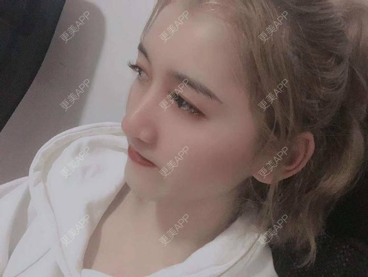 更美 - 最美的期待i的鼻形态修复经验 | 广州 | 鼻形态修复