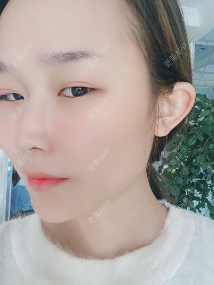 更美 - 阿喵    🐝的除皱瘦脸经验 | 除皱瘦脸 | 郑州
