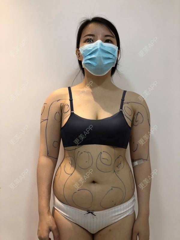 更美 - 更美用户5xL72sw7Ge的射频溶脂瘦手臂经验 | 射频溶脂瘦小腿 | 射频溶脂瘦大腿 | 射频溶脂瘦肩膀 | 射频溶脂瘦手臂 | 射频溶脂瘦背部