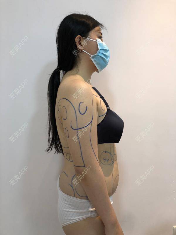 更美 - 更美用户5xL72sw7Ge的射频溶脂瘦手臂经验 | 射频溶脂瘦小腿 | 射频溶脂瘦大腿 | 射频溶脂瘦肩膀 | 射频溶脂瘦手臂 | 射频溶脂瘦背部