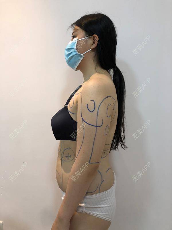 更美 - 更美用户5xL72sw7Ge的射频溶脂瘦手臂经验 | 射频溶脂瘦小腿 | 射频溶脂瘦大腿 | 射频溶脂瘦肩膀 | 射频溶脂瘦手臂 | 射频溶脂瘦背部