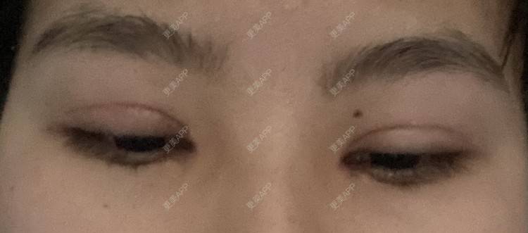 更美 - 更美用户LlGf9K7w9y的眼部多项经验 | 青岛 | 眼部多项