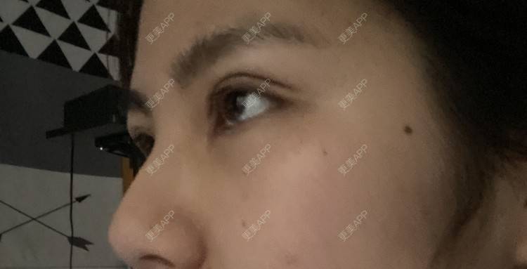 更美 - 更美用户LlGf9K7w9y的眼部多项经验 | 青岛 | 眼部多项