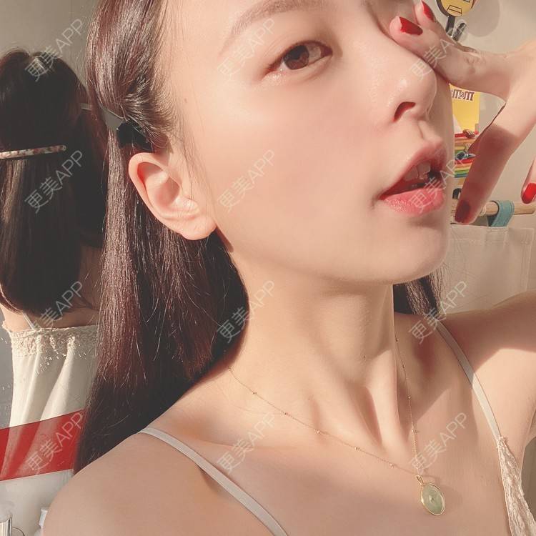 更美 - 更美用户9Nt11KbhXj的自体脂肪全面部填充经验 | 广州 | 自体脂肪全面部填充 | 视频日记