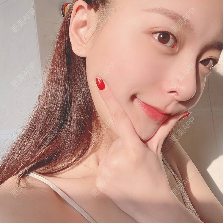 更美 - 更美用户9Nt11KbhXj的自体脂肪全面部填充经验 | 广州 | 自体脂肪全面部填充 | 视频日记