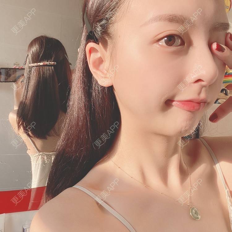 更美 - 更美用户9Nt11KbhXj的自体脂肪全面部填充经验 | 广州 | 自体脂肪全面部填充 | 视频日记