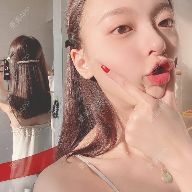 更美 - 更美用户9Nt11KbhXj的自体脂肪全面部填充经验 | 广州 | 自体脂肪全面部填充 | 视频日记