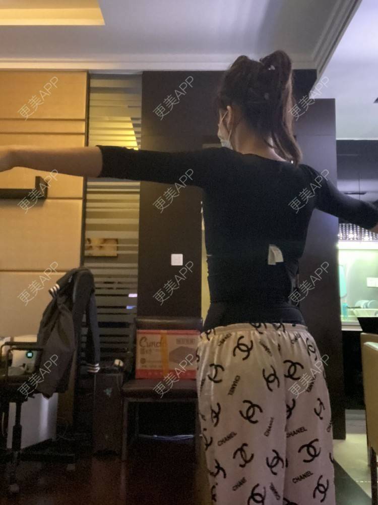 更美 - 更美用户KeZigsBQ7k的射频溶脂瘦手臂经验 | 广州 | 射频溶脂瘦手臂