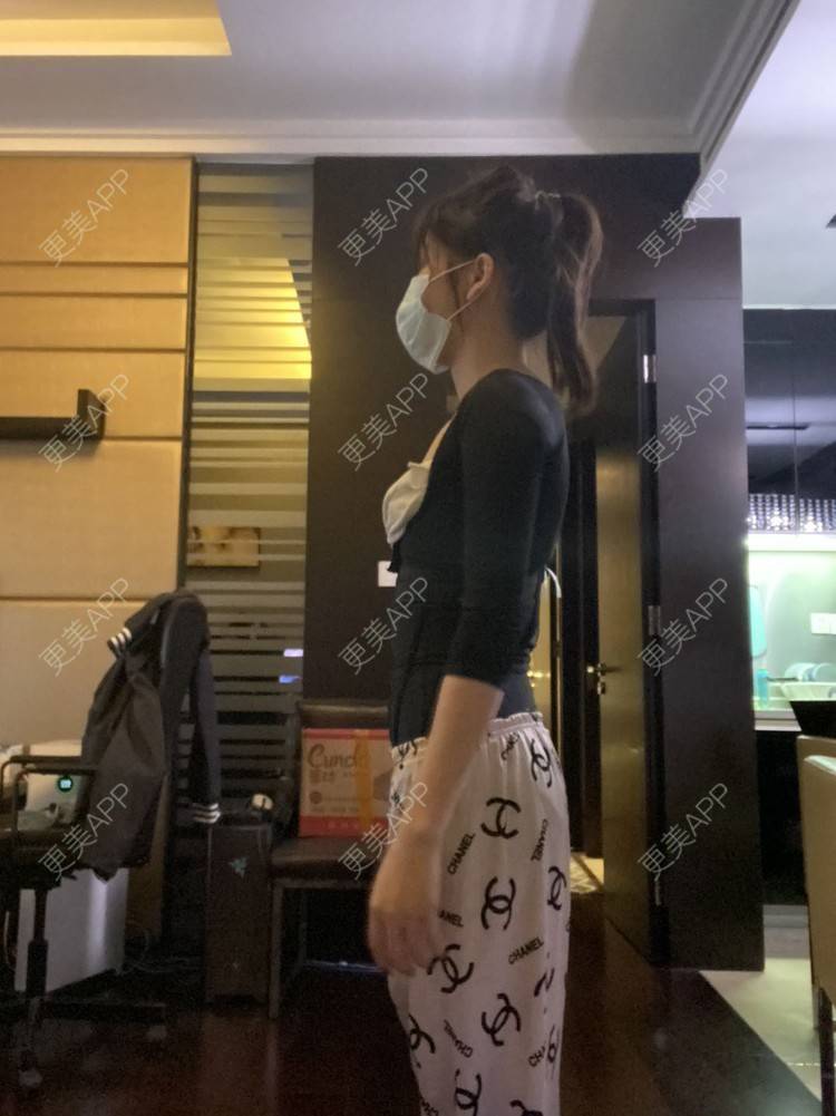 更美 - 更美用户KeZigsBQ7k的射频溶脂瘦手臂经验 | 广州 | 射频溶脂瘦手臂