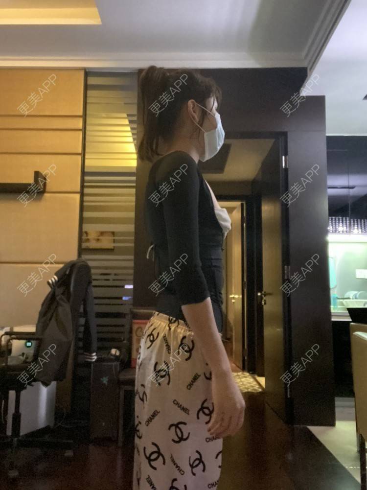 更美 - 更美用户KeZigsBQ7k的射频溶脂瘦手臂经验 | 广州 | 射频溶脂瘦手臂