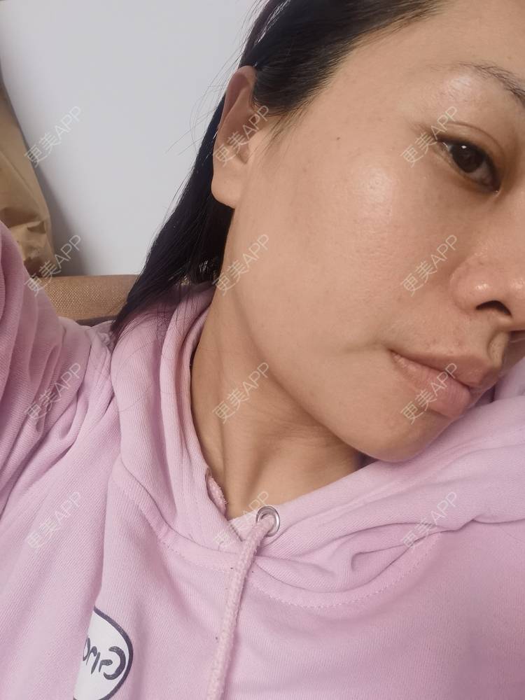 更美 - 油腻叉烧包的皮秒激光经验 | 广州 | 皮秒激光
