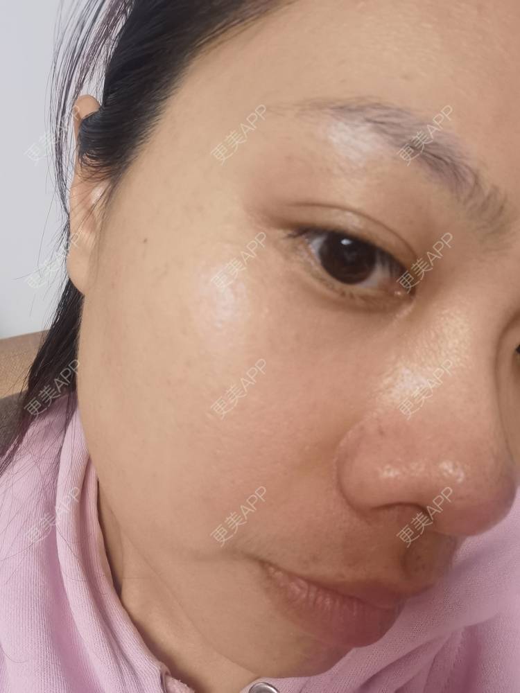 更美 - 油腻叉烧包的皮秒激光经验 | 广州 | 皮秒激光