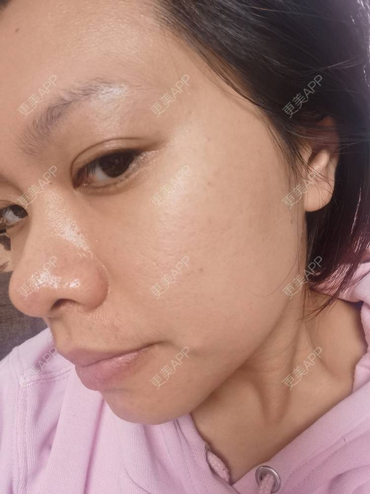 更美 - 油腻叉烧包的皮秒激光经验 | 广州 | 皮秒激光