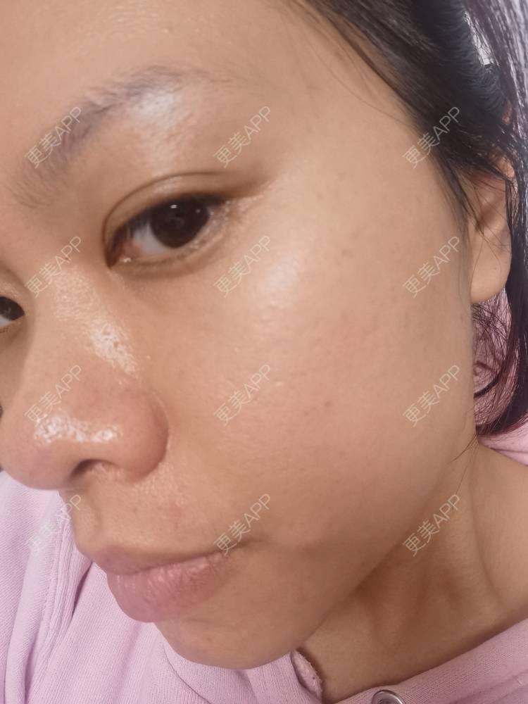更美 - 油腻叉烧包的皮秒激光经验 | 广州 | 皮秒激光