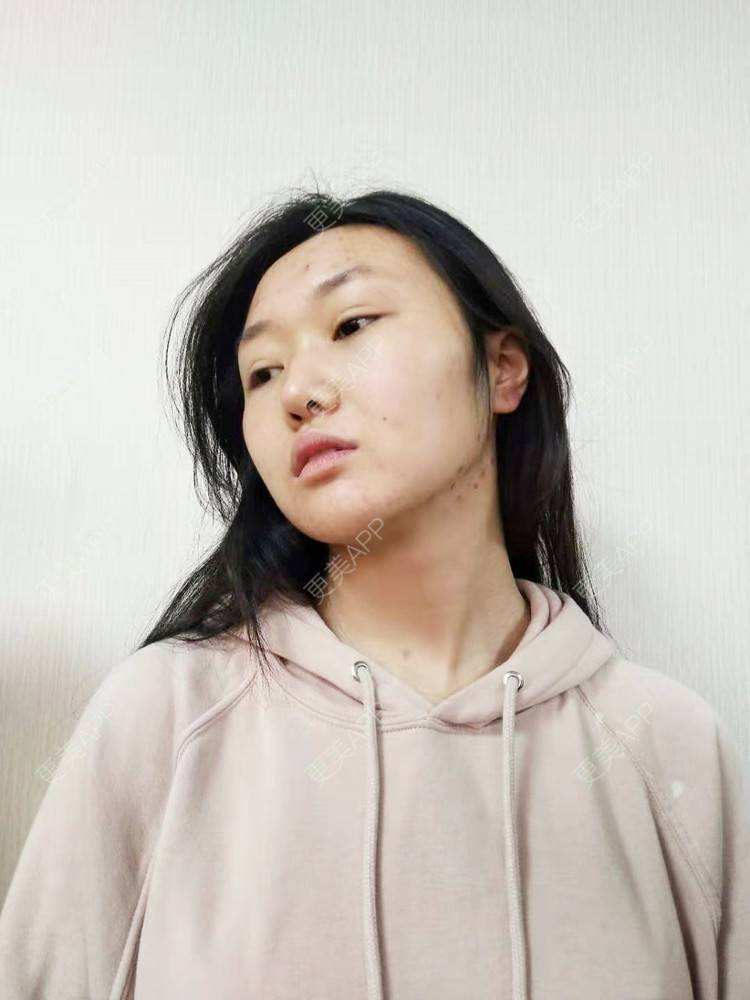 更美 - 更美用户xMMzQlCf62的红蓝光清痘经验 | 红蓝光清痘 | 祛疤痕痘印 | 针清清痘 | 成都
