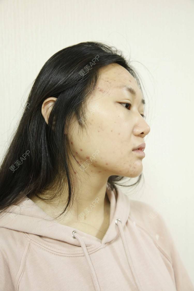 更美 - 更美用户xMMzQlCf62的红蓝光清痘经验 | 红蓝光清痘 | 祛疤痕痘印 | 针清清痘 | 成都
