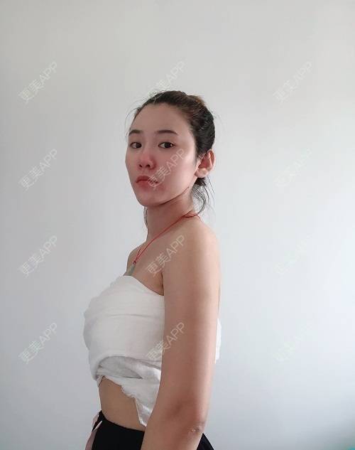 更美用户g8sryfm0rs的丰胸隆胸日记