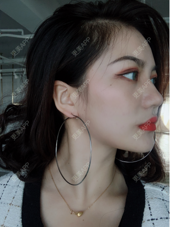 更美 - 薄荷喵&的隆鼻经验 | 隆鼻 | 武汉