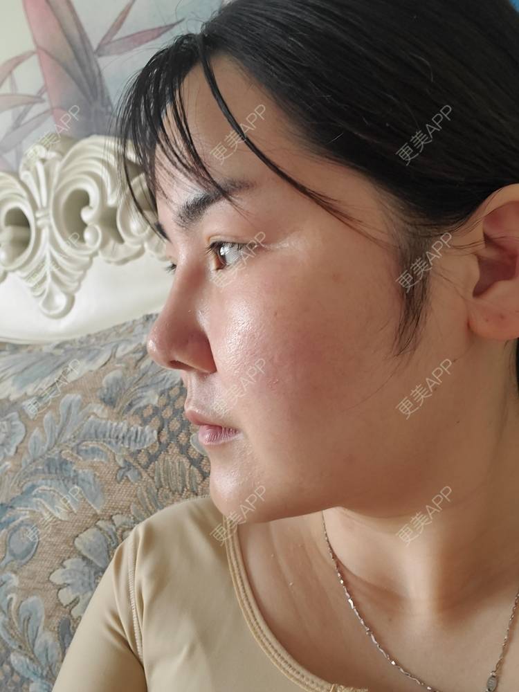 更美 - 夏天盛开的向日葵的硅胶隆鼻经验 | 硅胶隆鼻 | 郑州