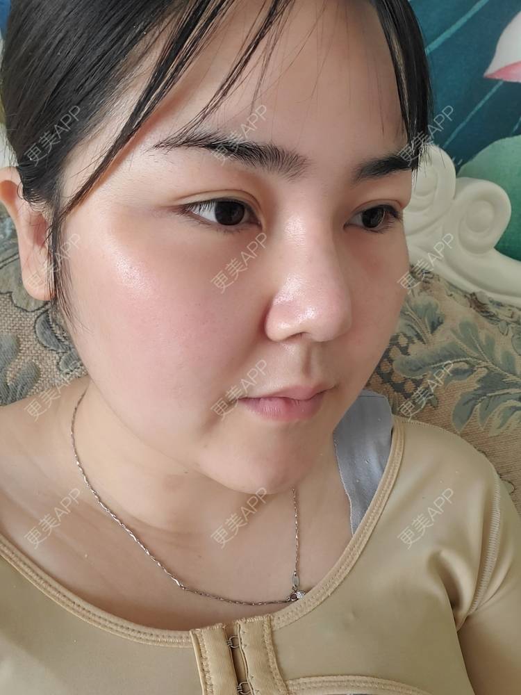 更美 - 夏天盛开的向日葵的硅胶隆鼻经验 | 硅胶隆鼻 | 郑州