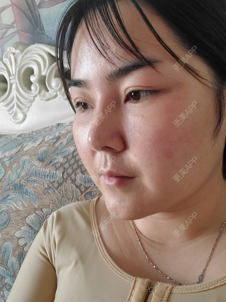 更美 - 夏天盛开的向日葵的硅胶隆鼻经验 | 硅胶隆鼻 | 郑州