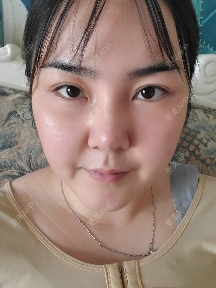 更美 - 夏天盛开的向日葵的硅胶隆鼻经验 | 硅胶隆鼻 | 郑州