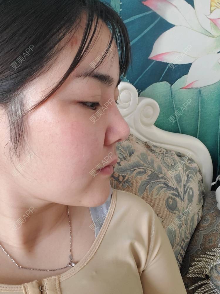 更美 - 夏天盛开的向日葵的硅胶隆鼻经验 | 硅胶隆鼻 | 郑州