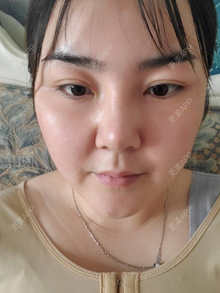 更美 - 夏天盛开的向日葵的硅胶隆鼻经验 | 硅胶隆鼻 | 郑州