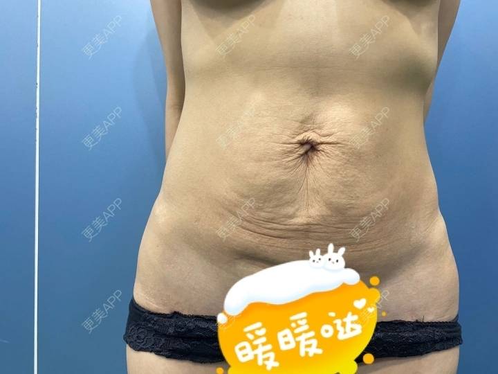 更美 - 长星媛的腹部吸脂经验 | 腹部吸脂 | 上海