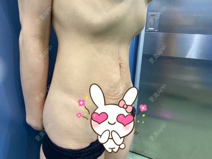 更美 - 长星媛的腹部吸脂经验 | 腹部吸脂 | 上海