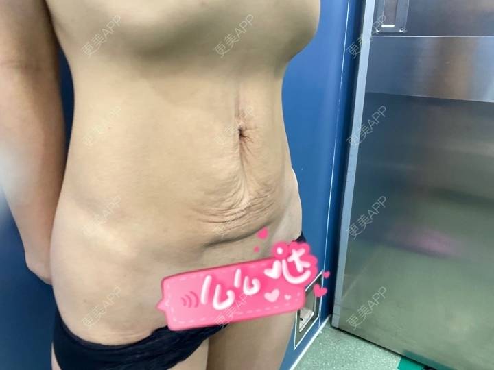 更美 - 长星媛的腹部吸脂经验 | 腹部吸脂 | 上海