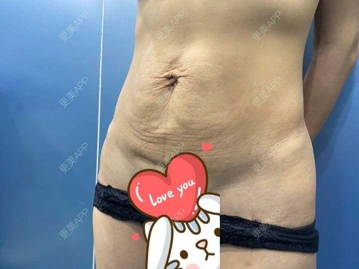 更美 - 长星媛的腹部吸脂经验 | 腹部吸脂 | 上海