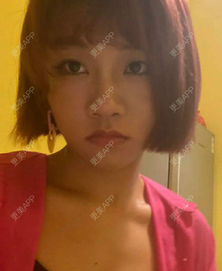 更美 - 更美用户wWvL71jaU3的颧骨颧弓经验 | 淮安 | 颧骨颧弓