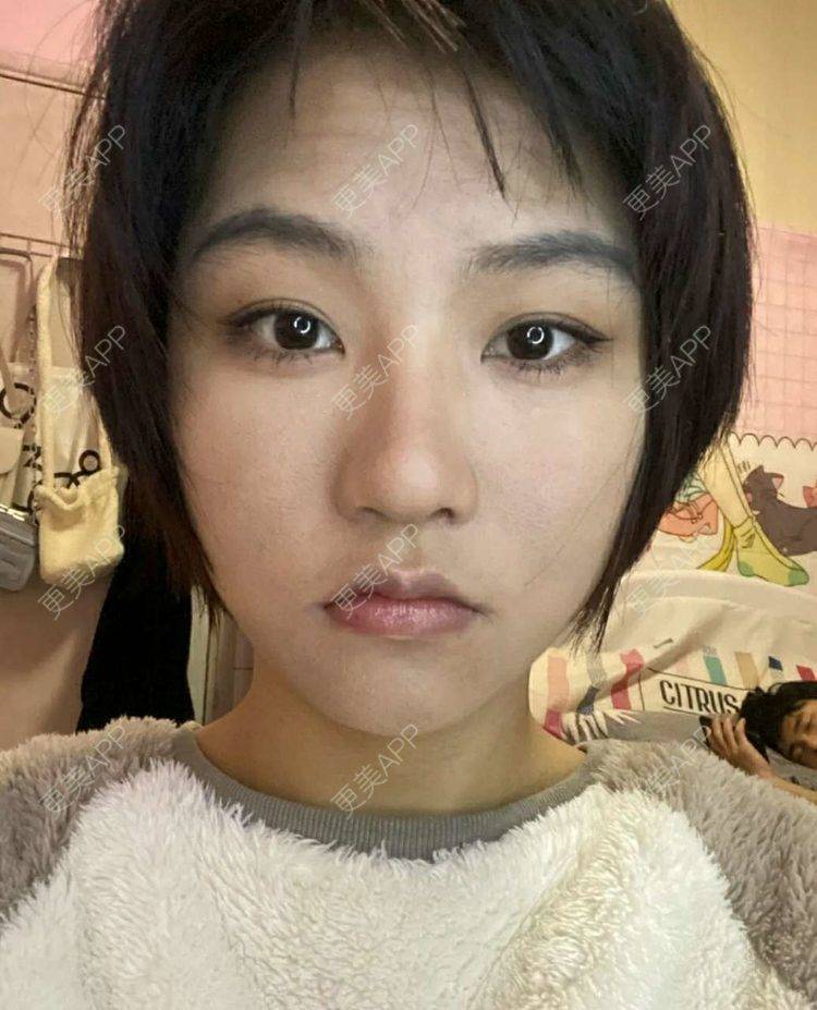 更美 - 更美用户wWvL71jaU3的颧骨颧弓经验 | 淮安 | 颧骨颧弓