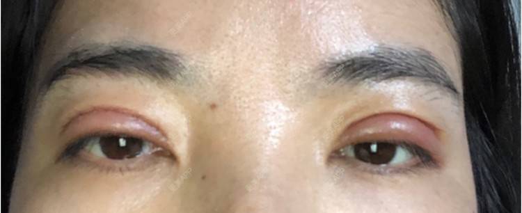 更美 - 更美用户XWC5MlBxQa的全切双眼皮经验 | 全切双眼皮 | 上海