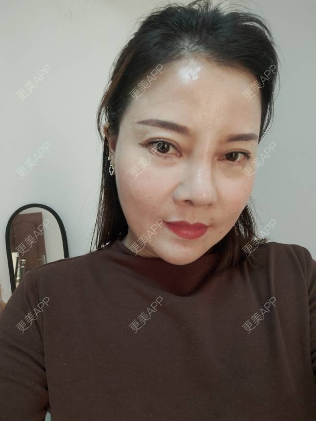 更美 - 更美用户xZI1wSP5Ch的隆鼻经验 | 隆鼻 | 肋软骨隆鼻 | 自体肋软骨垫鼻基底 | 上海