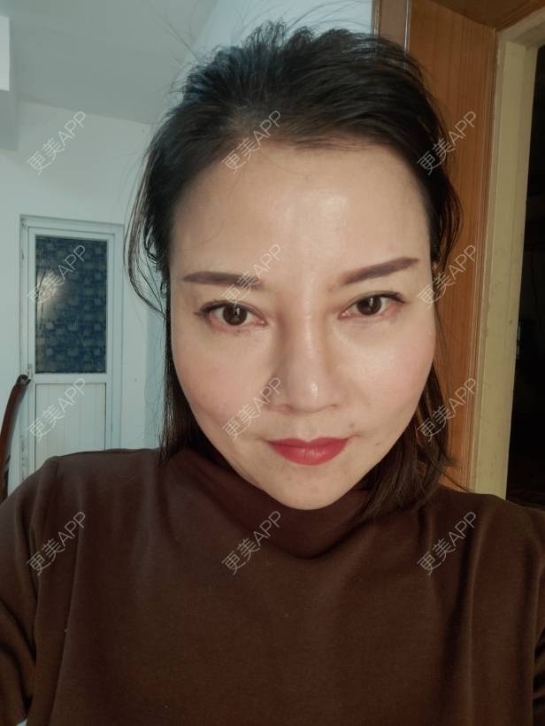 更美 - 更美用户xZI1wSP5Ch的隆鼻经验 | 隆鼻 | 肋软骨隆鼻 | 自体肋软骨垫鼻基底 | 上海