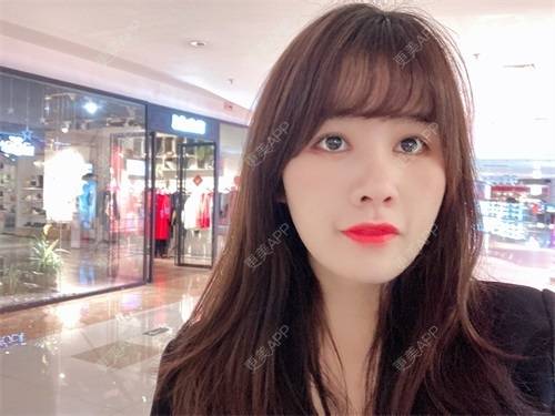 更美 - 更美用户8SCdWhYpRY的肋软骨隆鼻经验 | 成都 | 肋软骨隆鼻