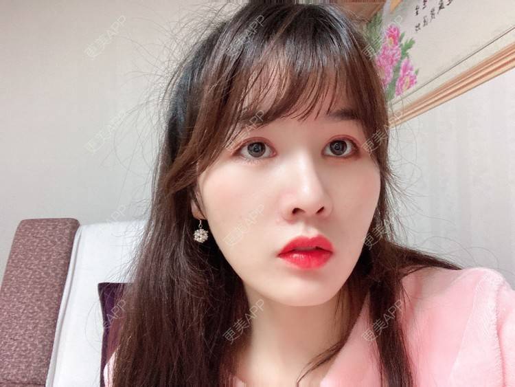 更美 - 更美用户8SCdWhYpRY的肋软骨隆鼻经验 | 成都 | 肋软骨隆鼻