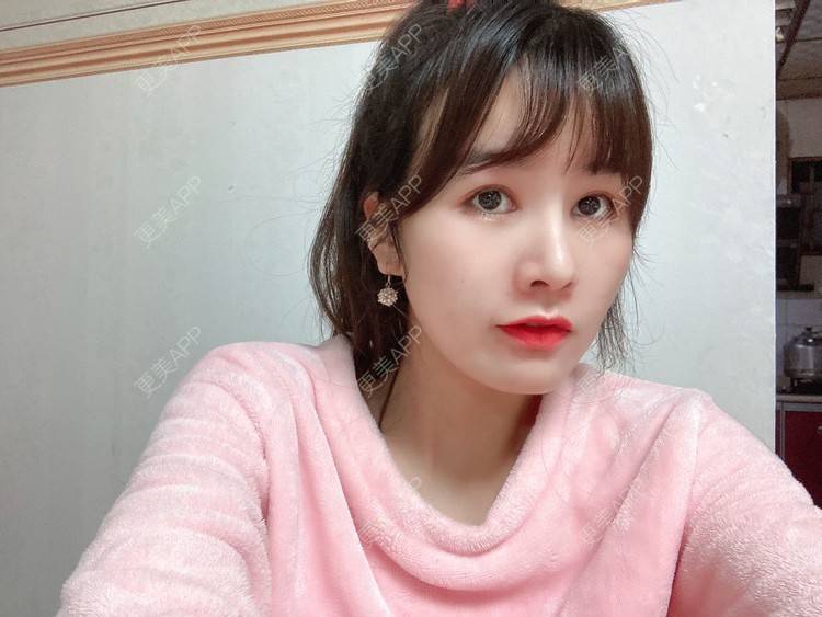 更美 - 更美用户8SCdWhYpRY的肋软骨隆鼻经验 | 成都 | 肋软骨隆鼻