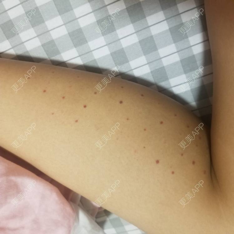 更美 - 更美用户UeGT7GDDcx的注射塑形腿部经验 | 注射塑形腿部 | 成都
