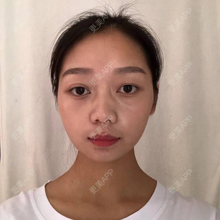 更美 - 更美用户1P9auHsFVF的水氧活肤经验 | 水氧活肤 | 长沙