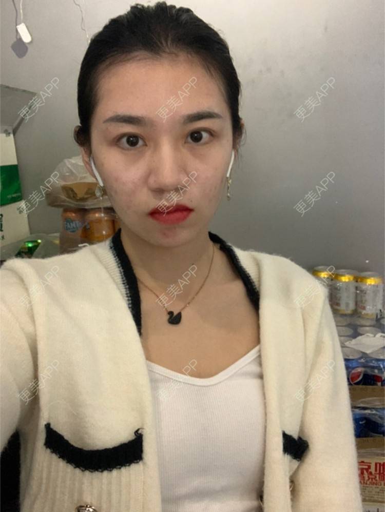更美 - 更美用户9Ullrmnx3O的玻尿酸泪沟经验 | 胶原蛋白丰泪沟