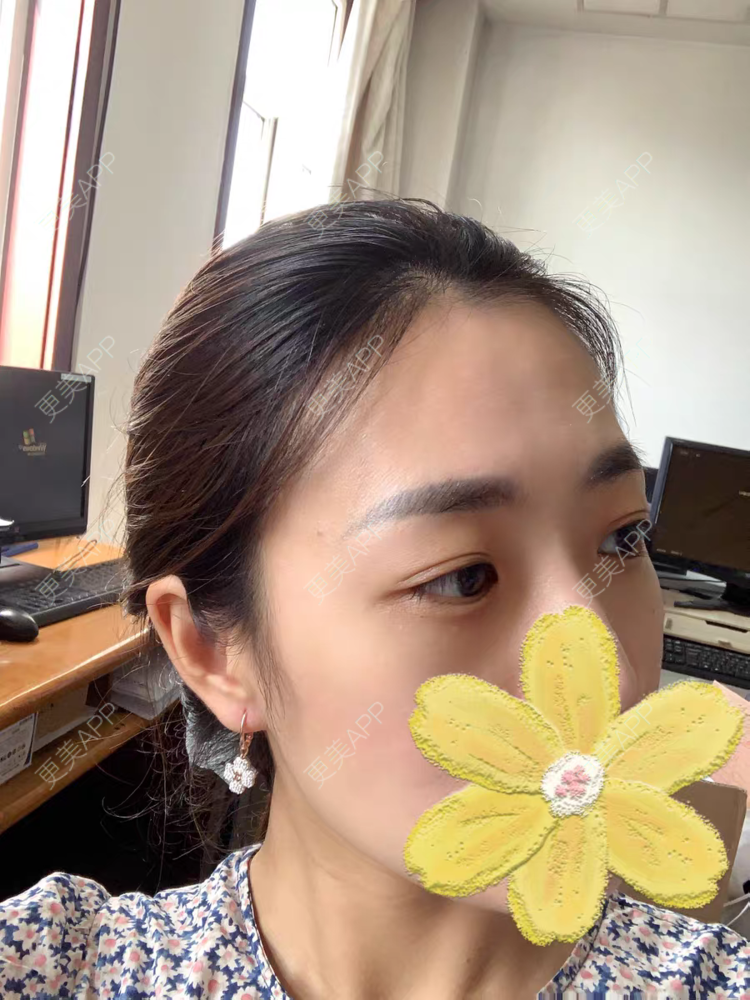 更美 - 我男神吴亦凡的眼部综合经验 | 眼部综合 | 西安