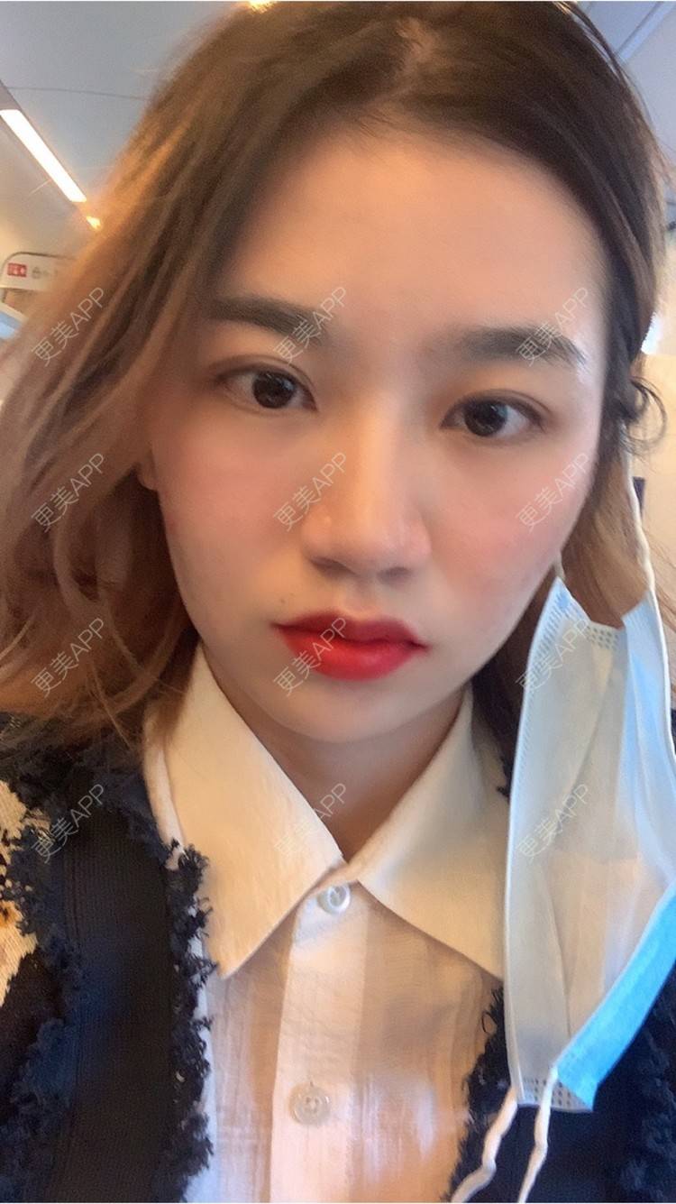 更美 - 更美用户9Ullrmnx3O的玻尿酸泪沟经验 | 胶原蛋白丰泪沟