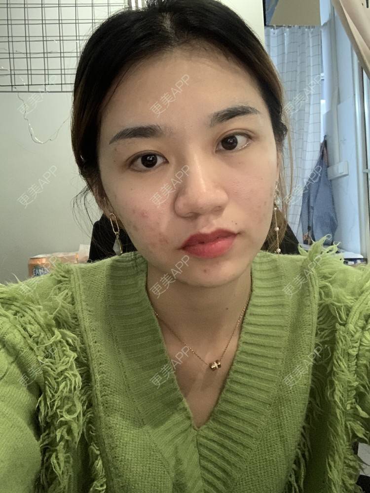 更美 - 更美用户9Ullrmnx3O的玻尿酸泪沟经验 | 玻尿酸泪沟 | 胶原蛋白丰泪沟