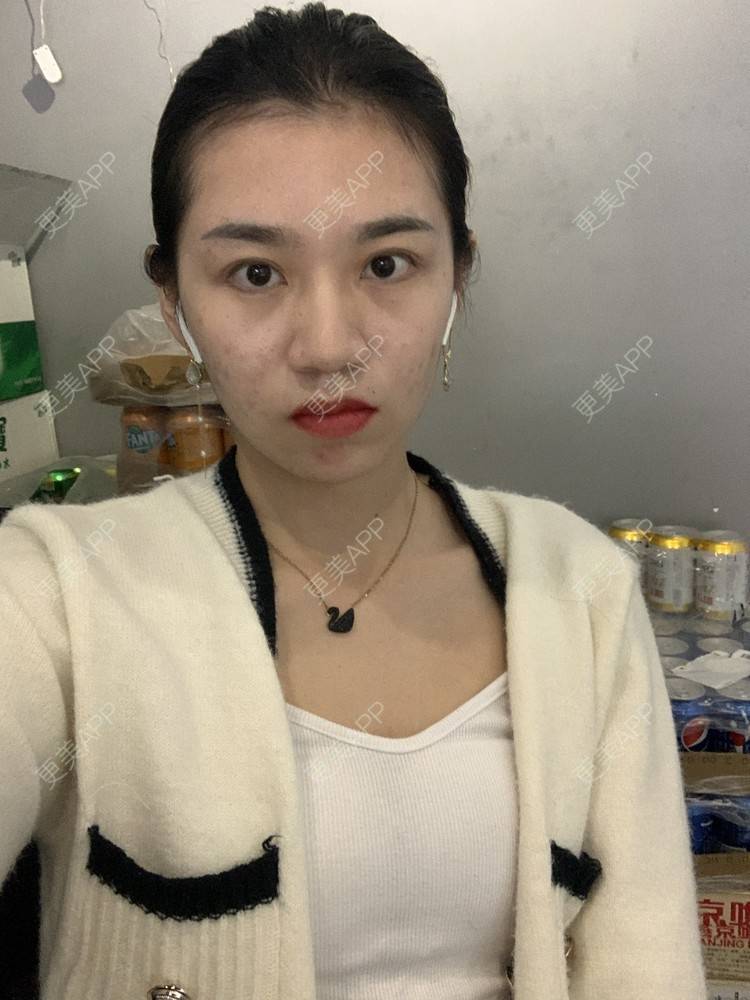 更美 - 更美用户9Ullrmnx3O的玻尿酸泪沟经验 | 玻尿酸泪沟 | 胶原蛋白丰泪沟